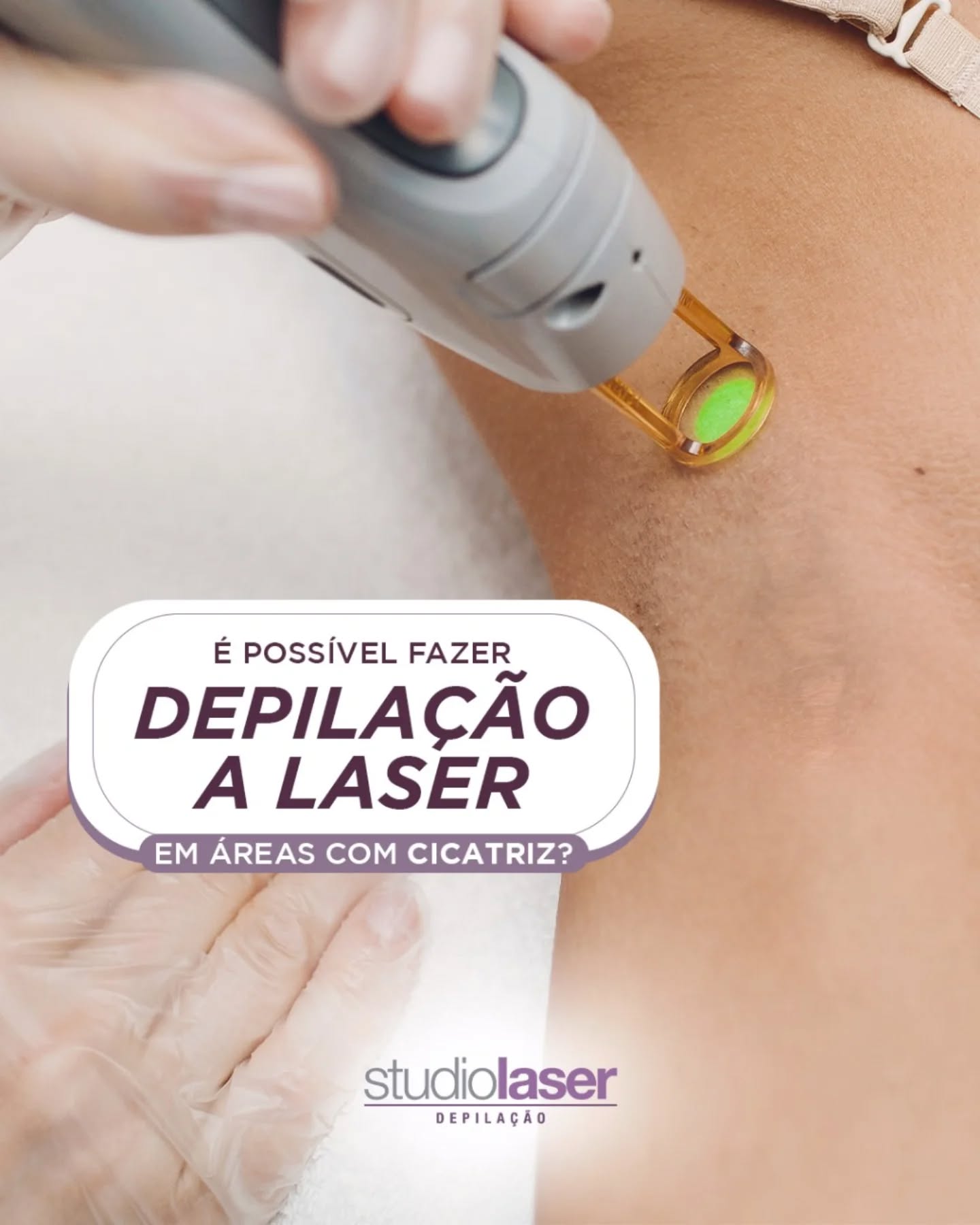 Depilação a Laser em Cicatrizes: Guia Seguro e Eficaz